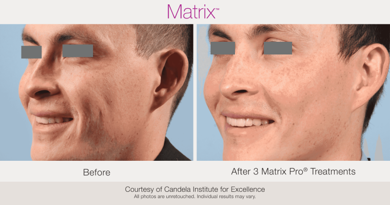 Skin Rejuvenation with Matrix-Before-After (1)