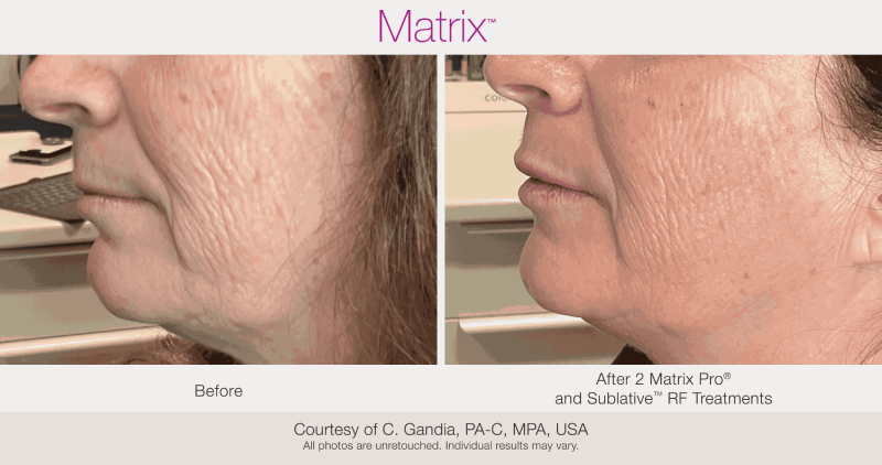 Skin Rejuvenation with Matrix-Before-After (10)