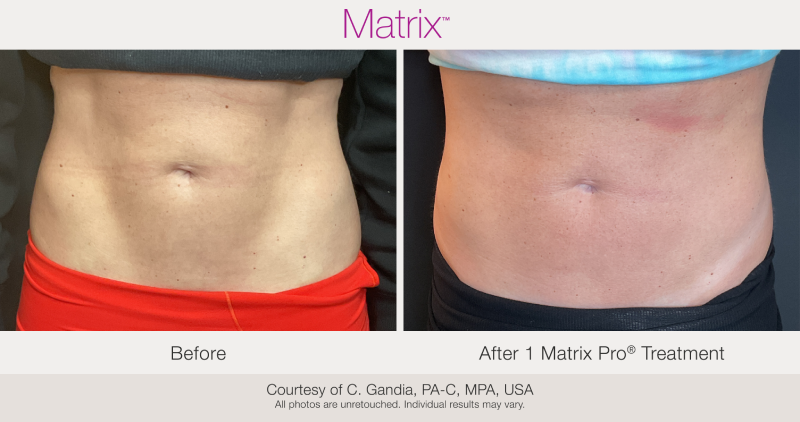 Skin Rejuvenation with Matrix-Before-After (13)
