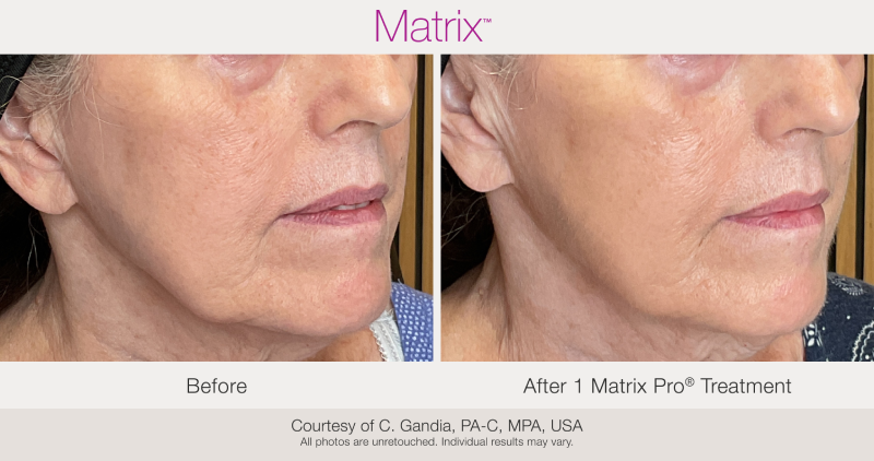 Skin Rejuvenation with Matrix-Before-After (14)