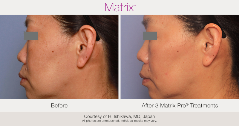 Skin Rejuvenation with Matrix-Before-After (15)