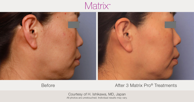Skin Rejuvenation with Matrix-Before-After (16)