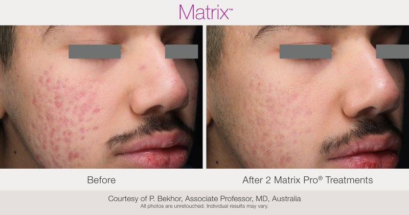 Skin Rejuvenation with Matrix-Before-After (19)