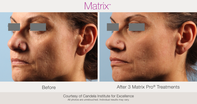 Skin Rejuvenation with Matrix-Before-After (2)