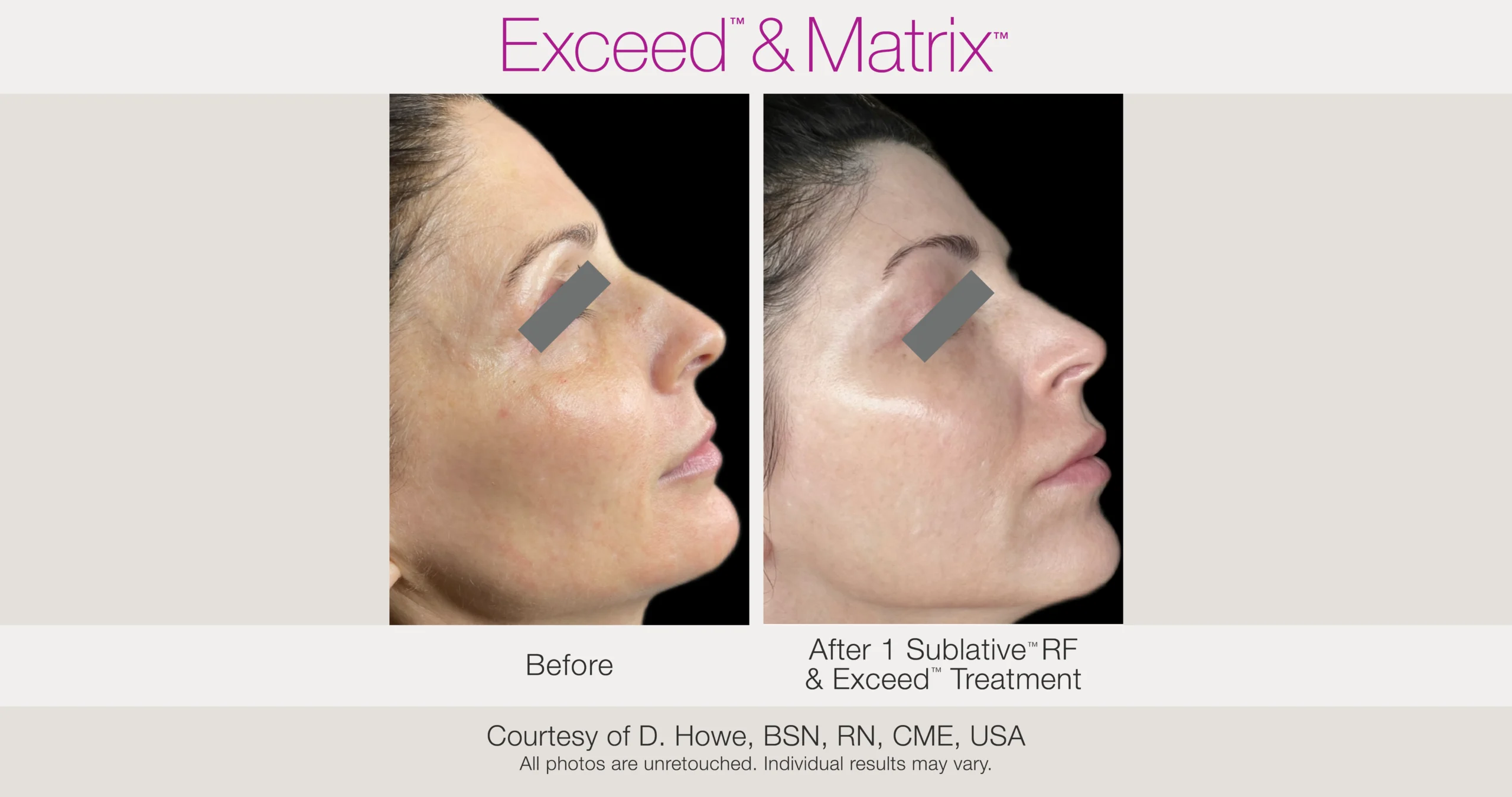 Skin Rejuvenation with Matrix-Before-After (21)