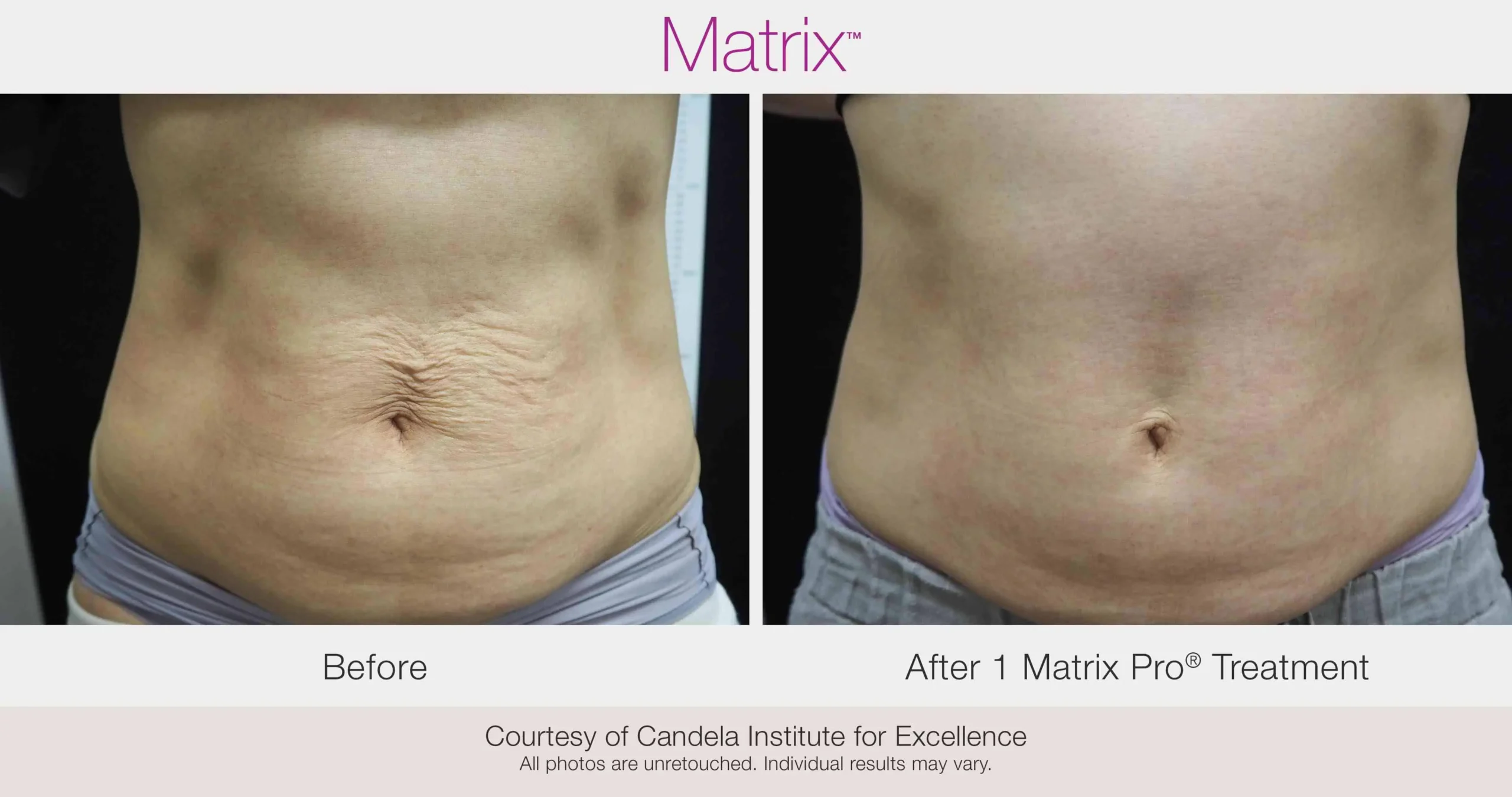 Skin Rejuvenation with Matrix-Before-After (32) (1)