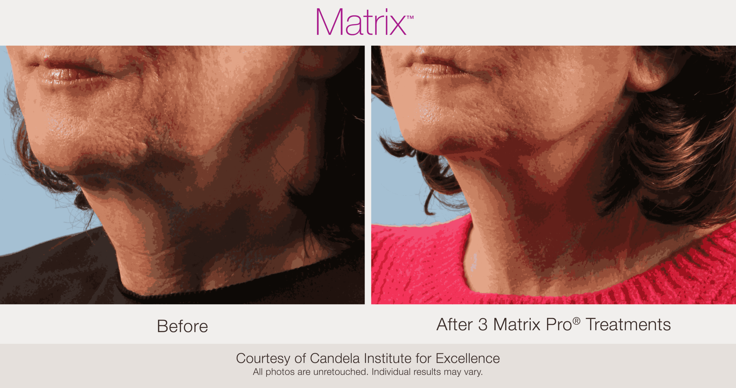 Skin Rejuvenation with Matrix-Before-After (33)