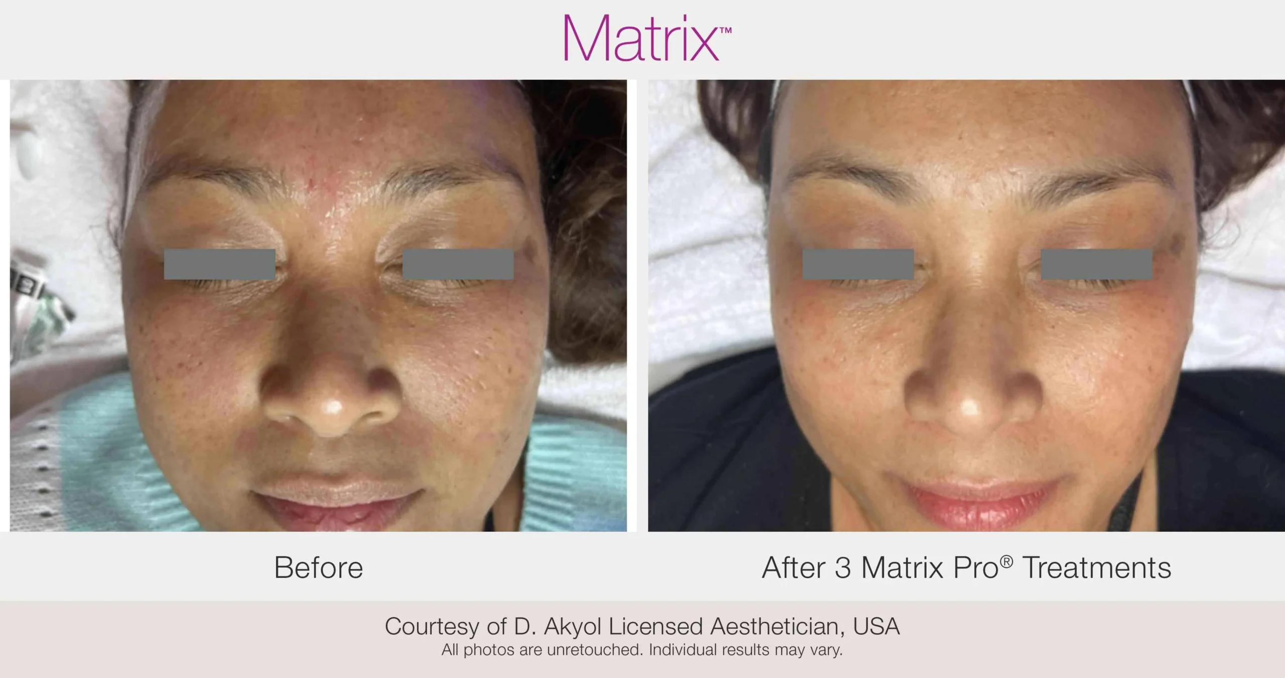Skin Rejuvenation with Matrix-Before-After (34) (1)