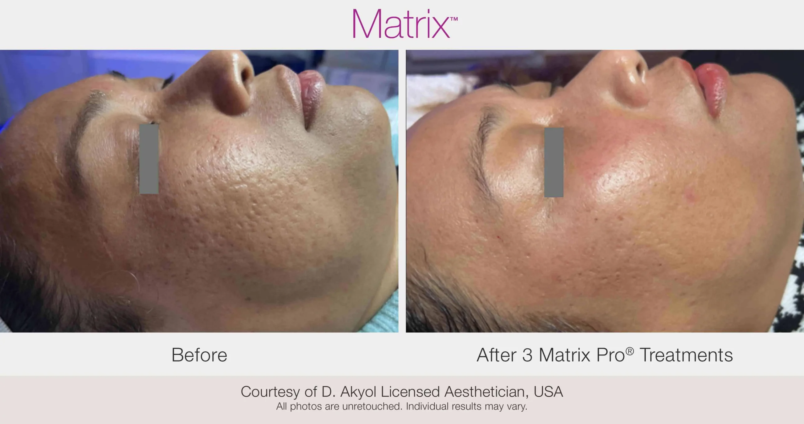 Skin Rejuvenation with Matrix-Before-After (35) (1)