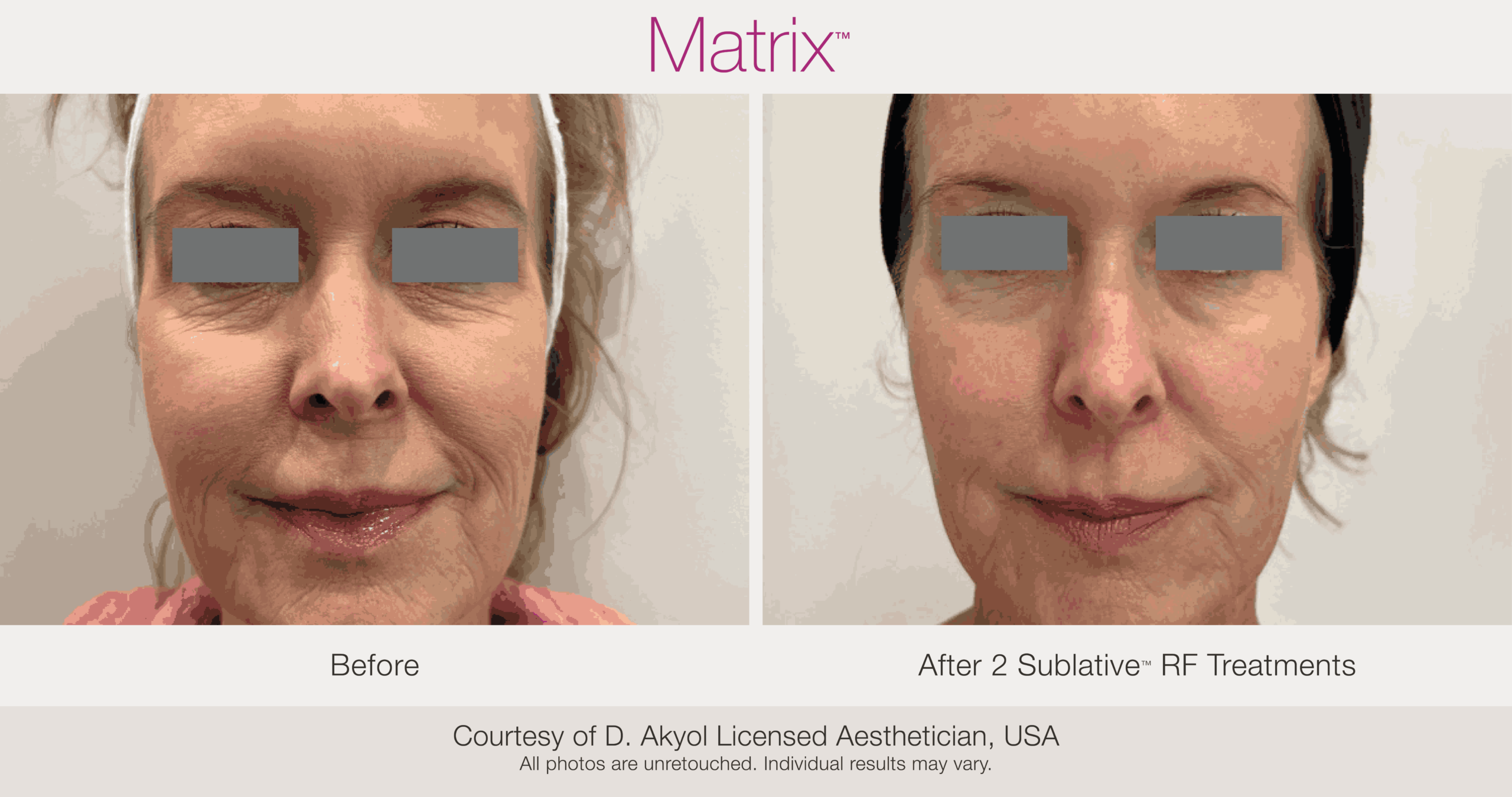 Skin Rejuvenation with Matrix-Before-After (37)