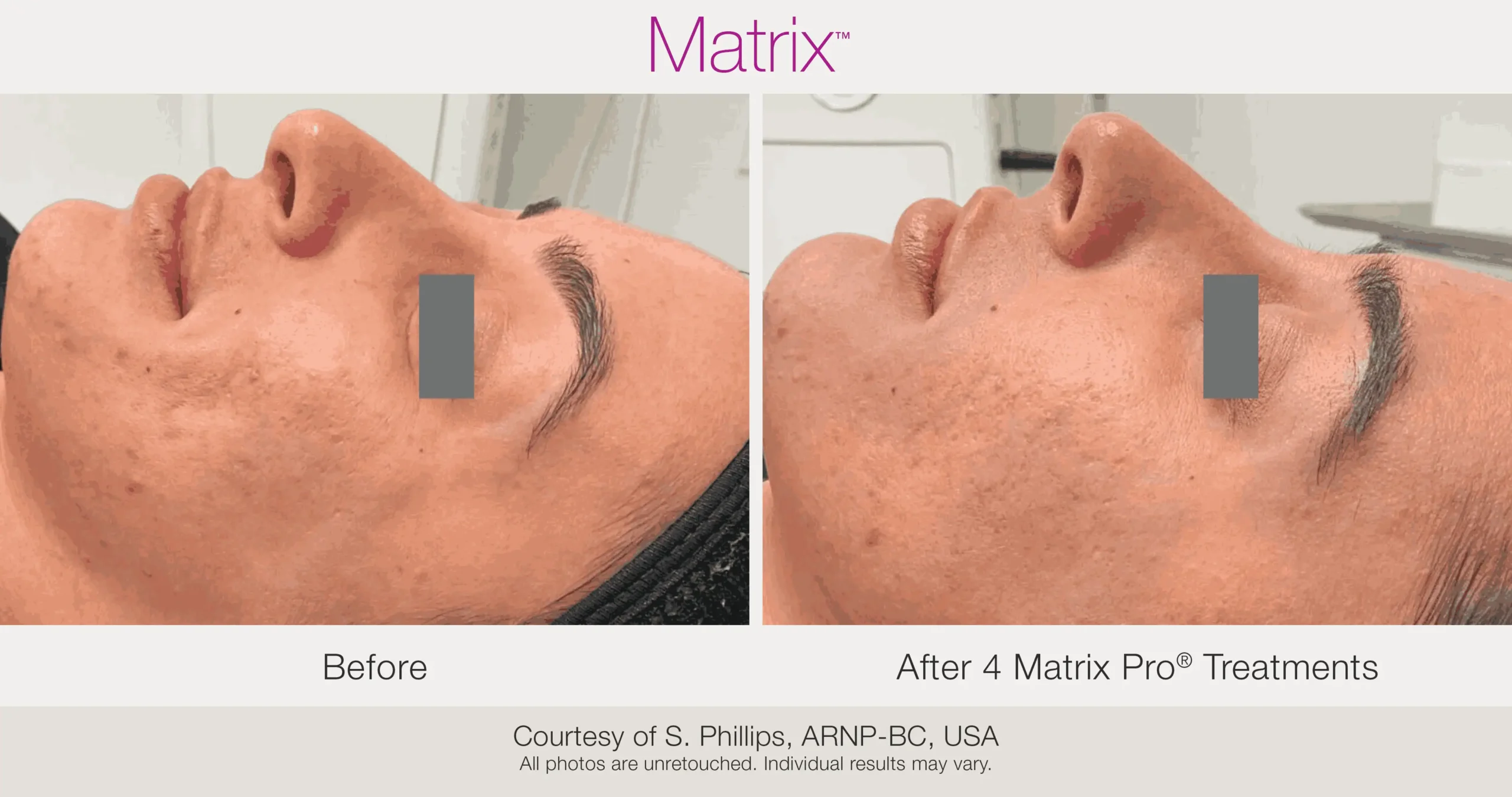 Skin Rejuvenation with Matrix-Before-After (49)