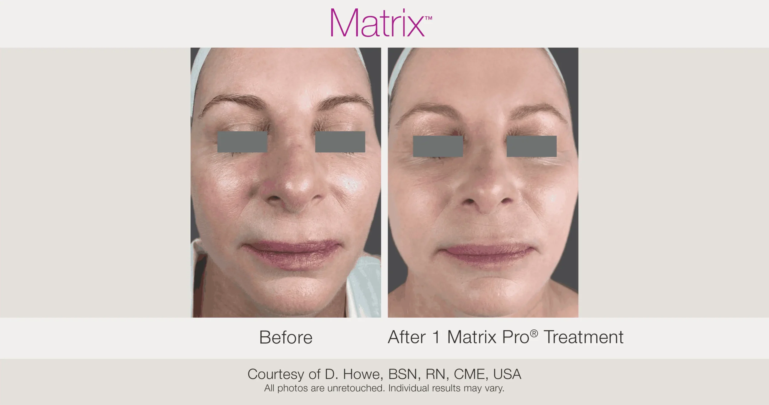 Skin Rejuvenation with Matrix-Before-After (55)