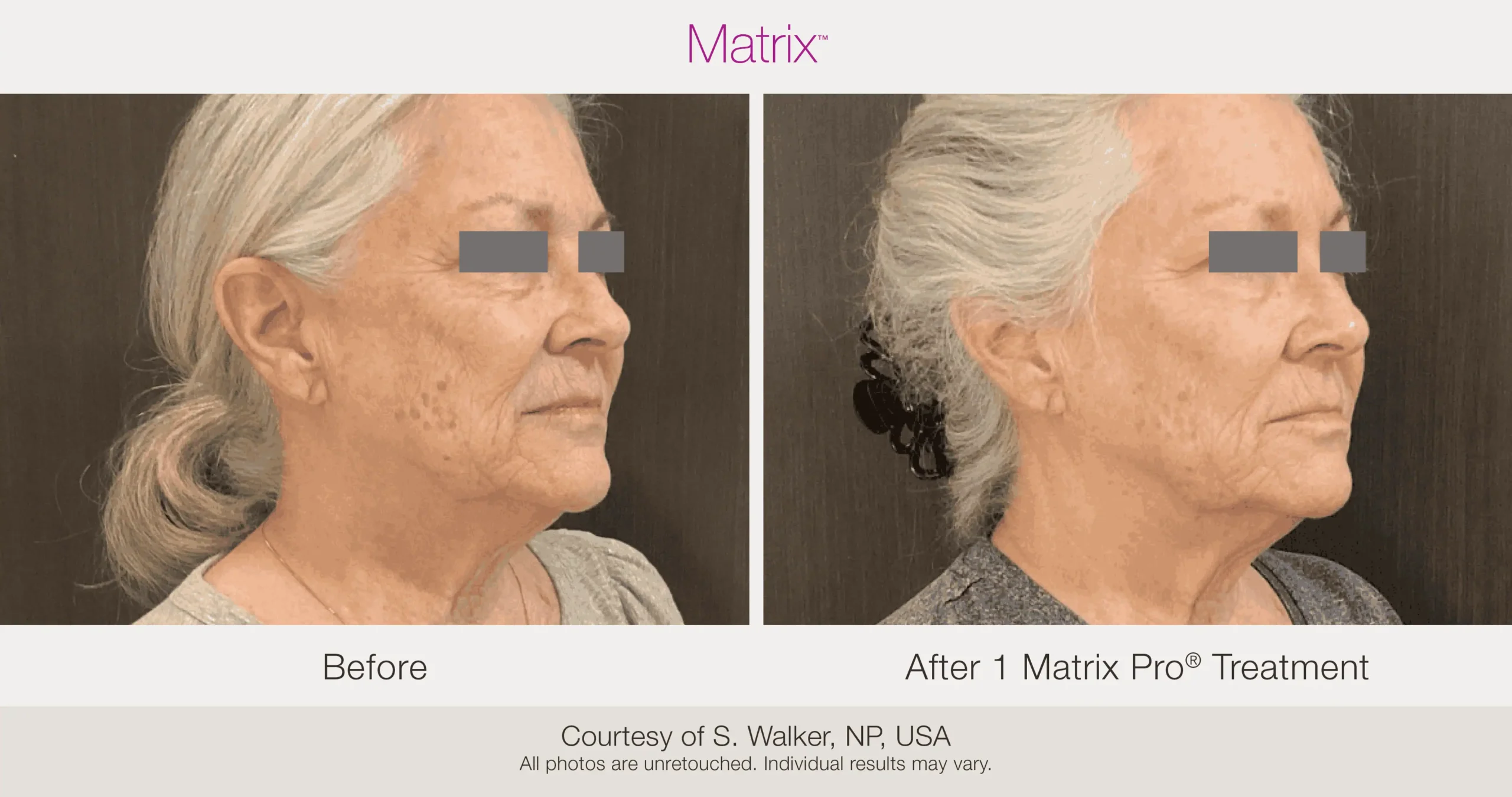 Skin Rejuvenation with Matrix-Before-After (58)