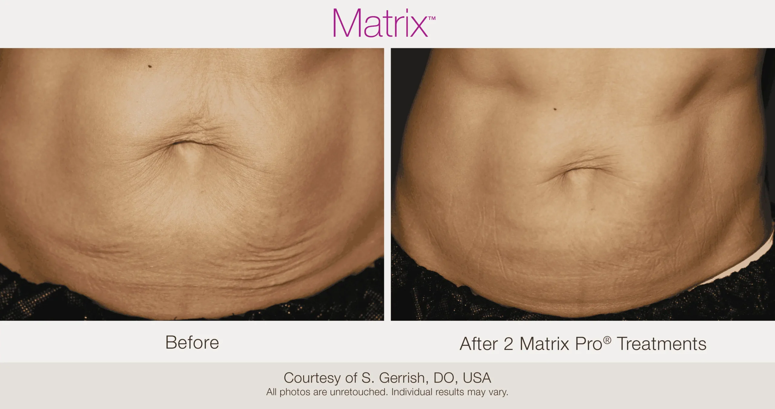 Skin Rejuvenation with Matrix-Before-After (61)