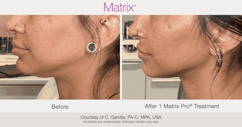 Skin Rejuvenation with Matrix-Before-After (7)
