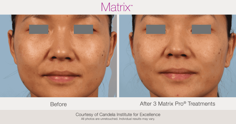 Skin Rejuvenation with Matrix-Before-After