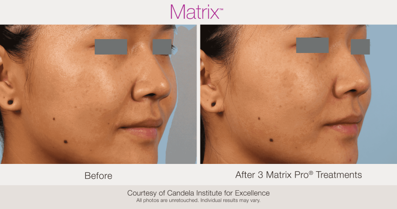 Skin Rejuvenation with Matrix-B & After