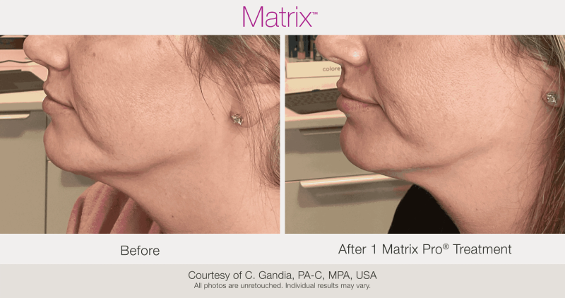 Skin Rejuvenation with Matrix-Before-After (11)