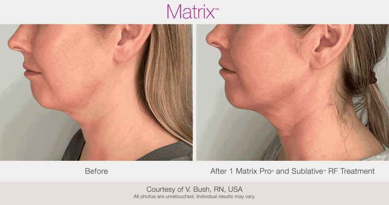 Skin Rejuvenation with Matrix-Before-After (12)