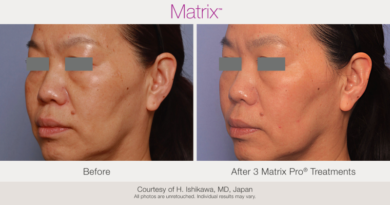 Skin Rejuvenation with Matrix-Before-After (17)