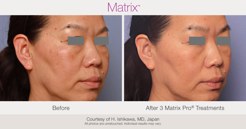 Skin Rejuvenation with Matrix-Before-After (18)