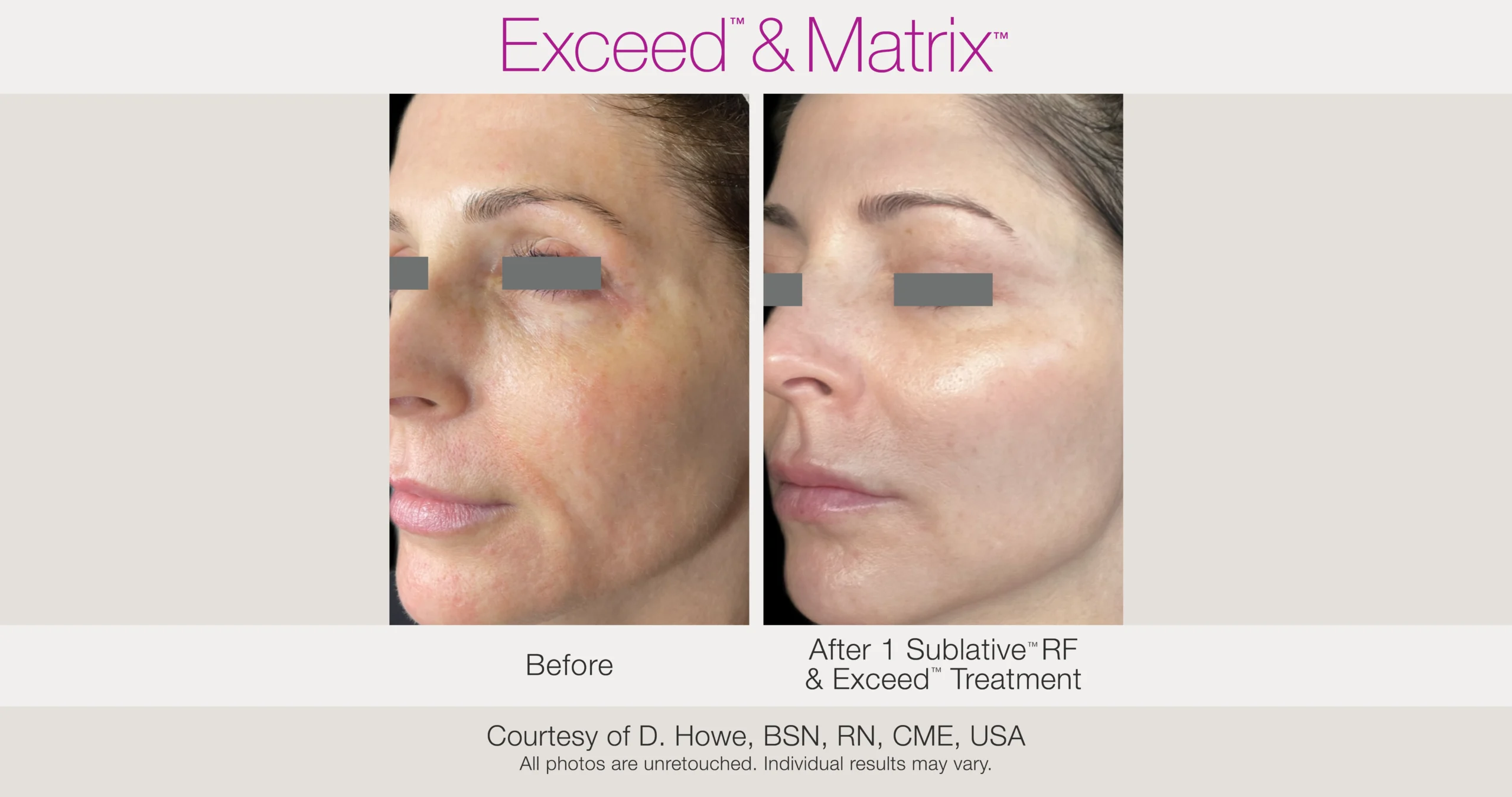 Skin Rejuvenation with Matrix-Before-After (20)