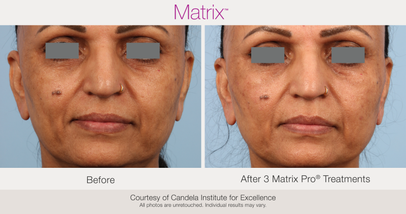 Skin Rejuvenation with Matrix-Before-After (3)