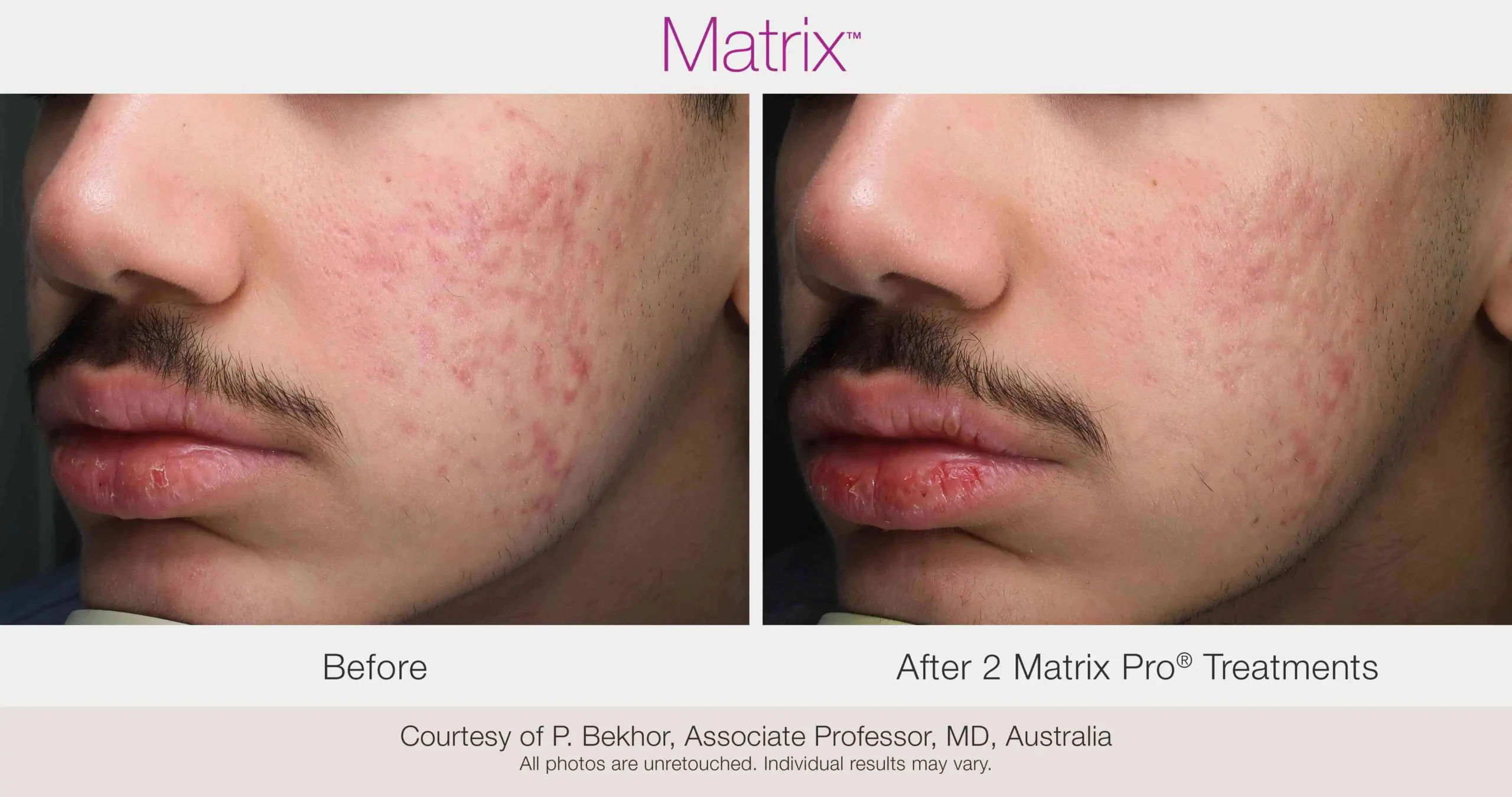 Skin Rejuvenation with Matrix-Before-After (33) (1)