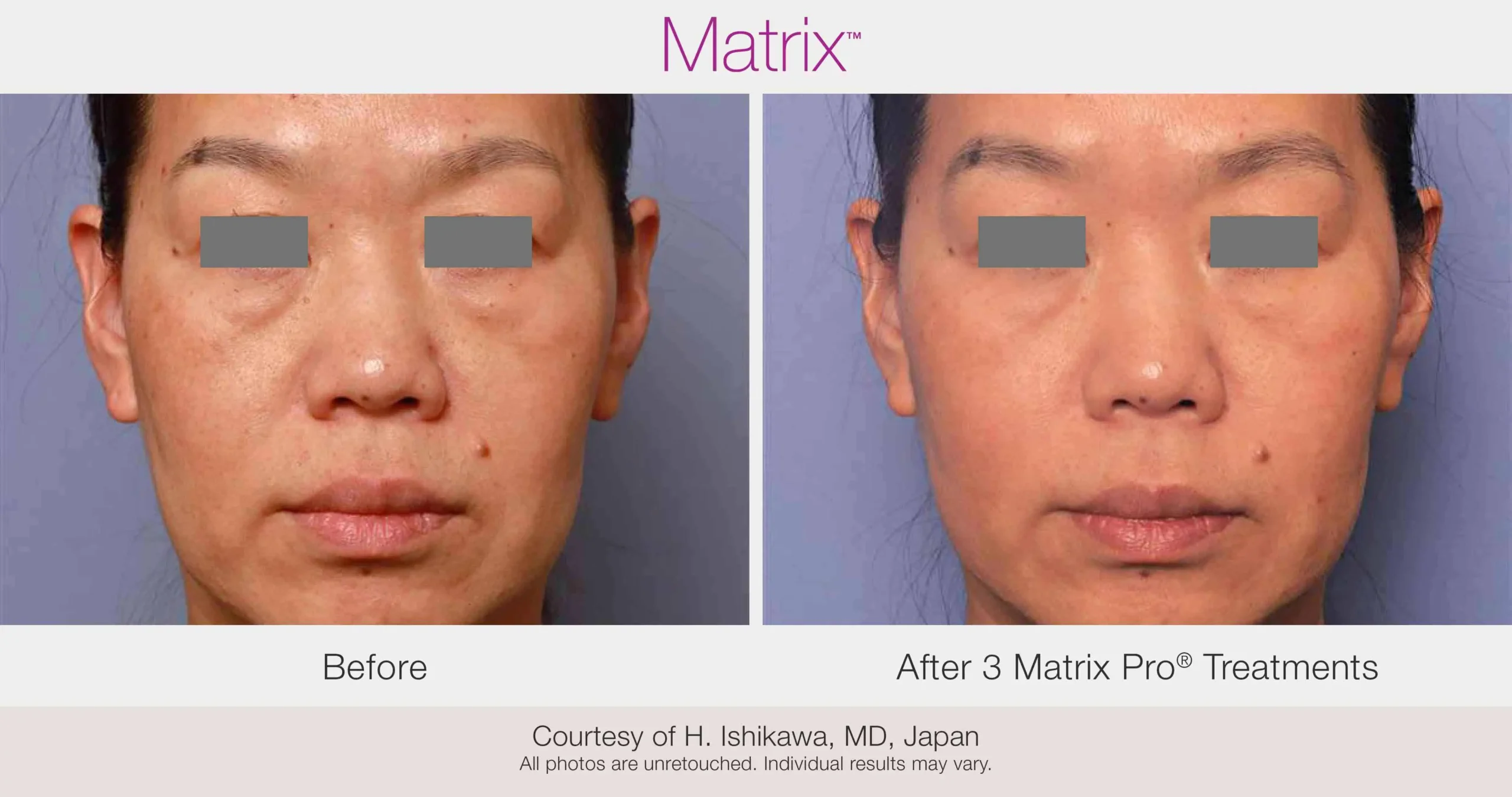 Skin Rejuvenation with Matrix-Before-After (36)