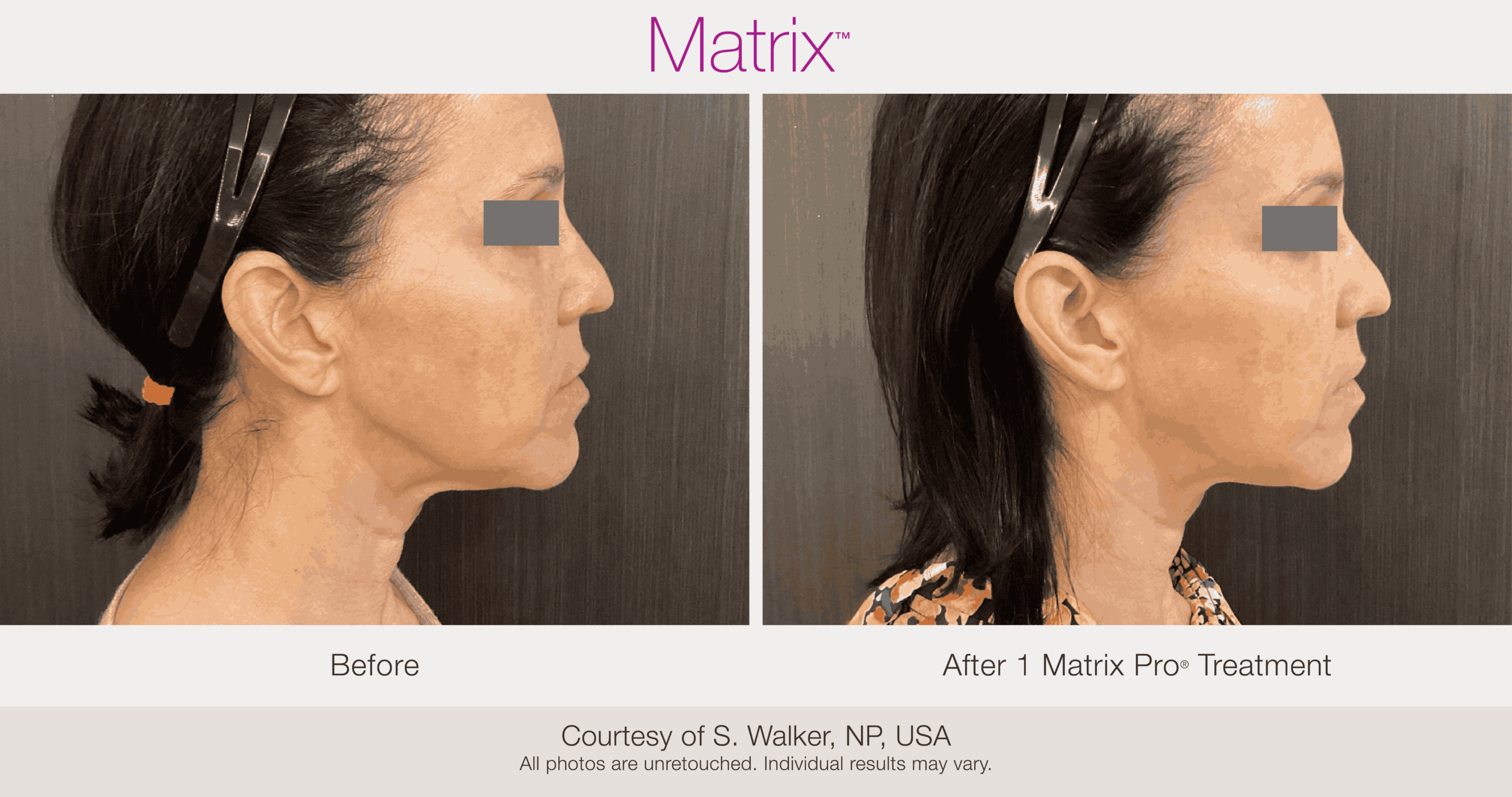 Skin Rejuvenation with Matrix-Before-After (38)