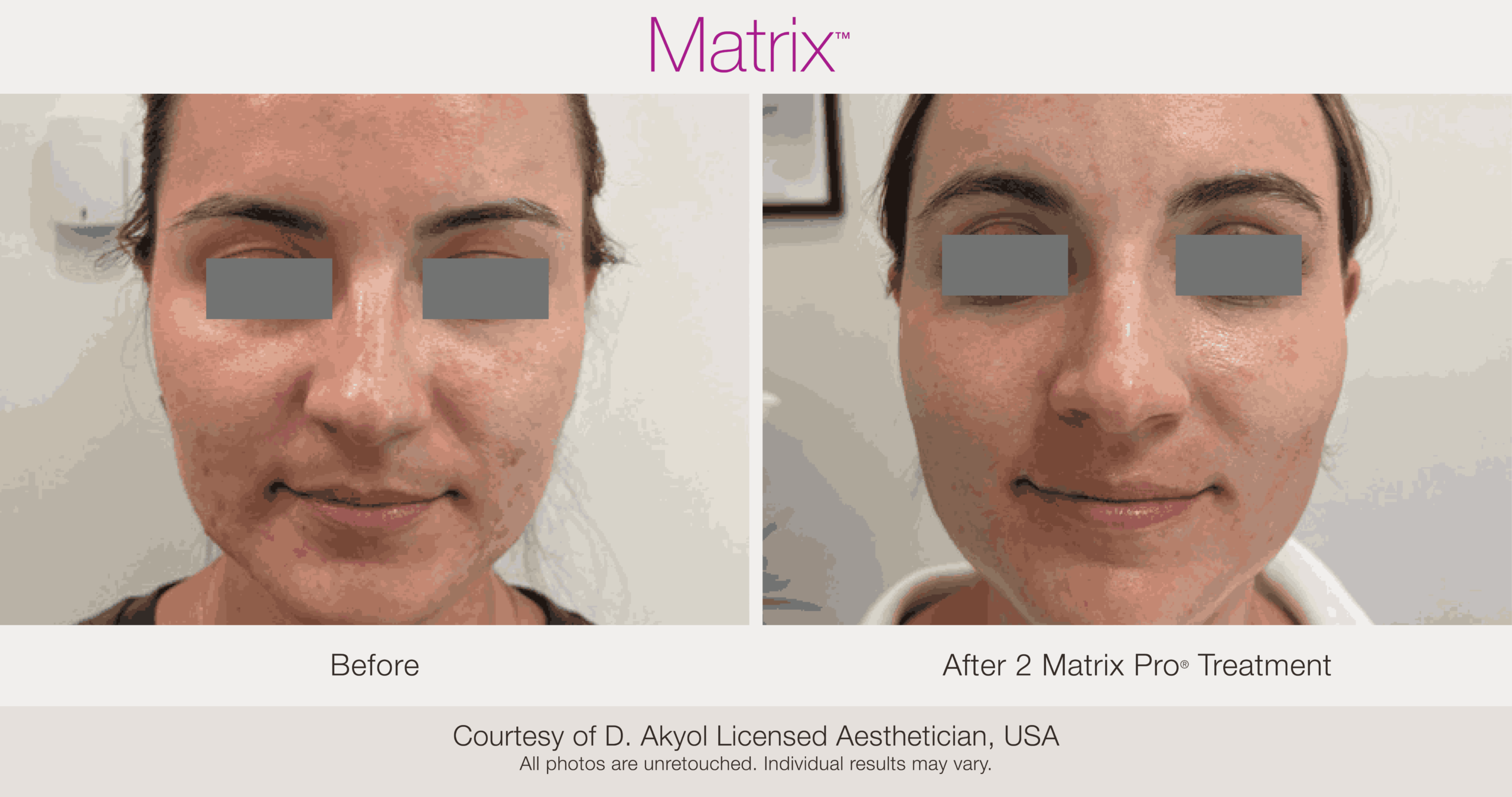 Skin Rejuvenation with Matrix-Before-After (39)