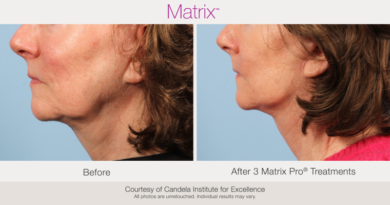 Skin Rejuvenation with Matrix-Before-After (4)