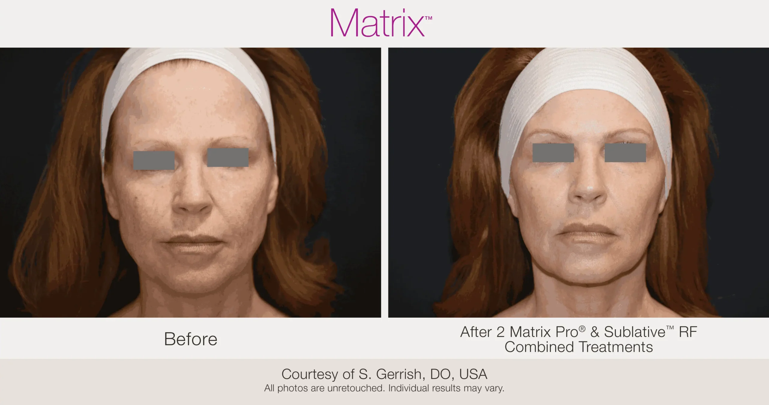 Skin Rejuvenation with Matrix-Before-After (41)