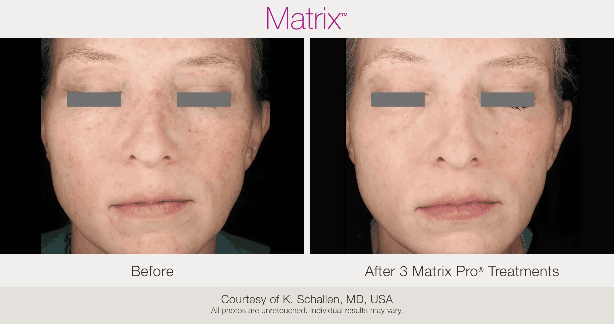 Skin Rejuvenation with Matrix-Before-After (42)