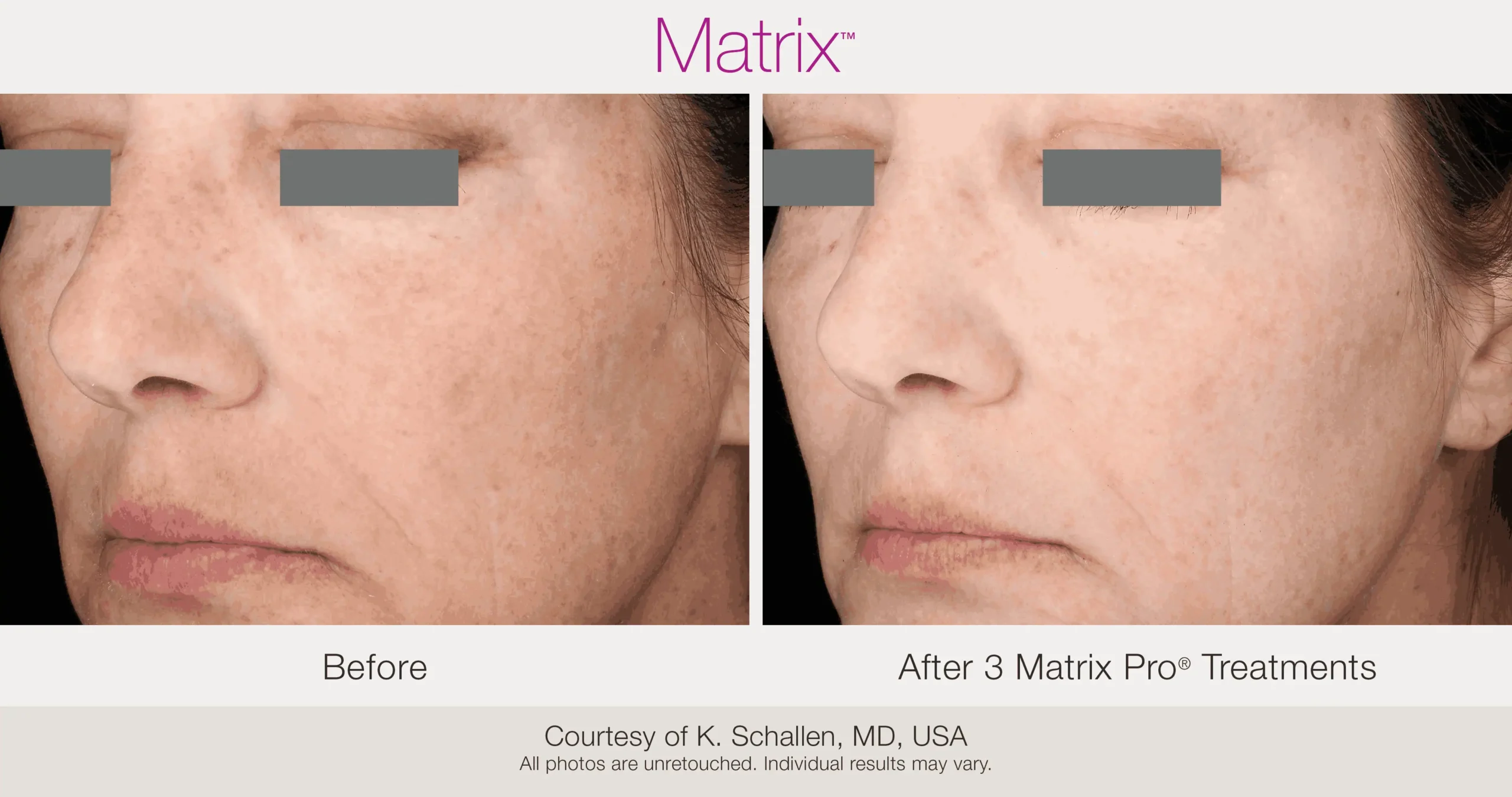 Skin Rejuvenation with Matrix-Before-After (43)