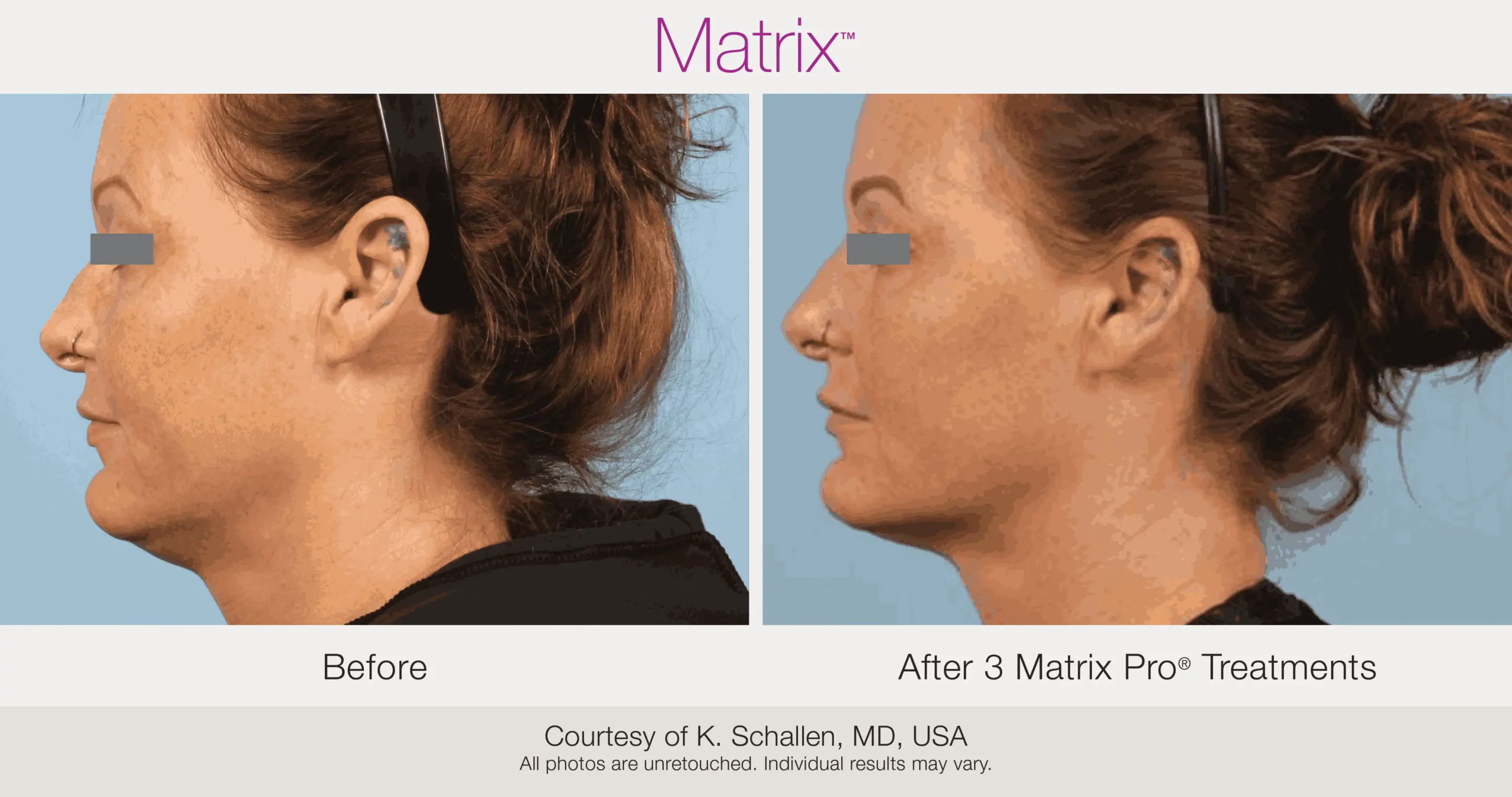 Skin Rejuvenation with Matrix-Before-After (44)