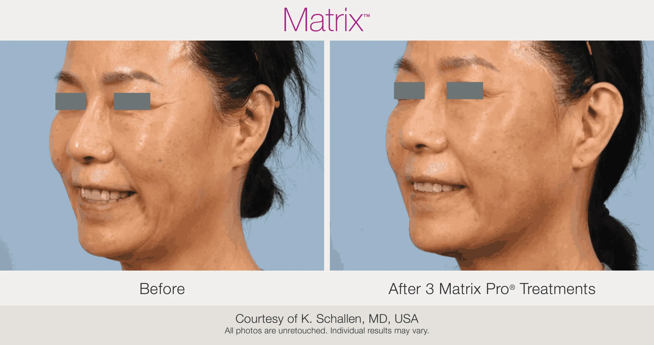Skin Rejuvenation with Matrix-Before-After (45)