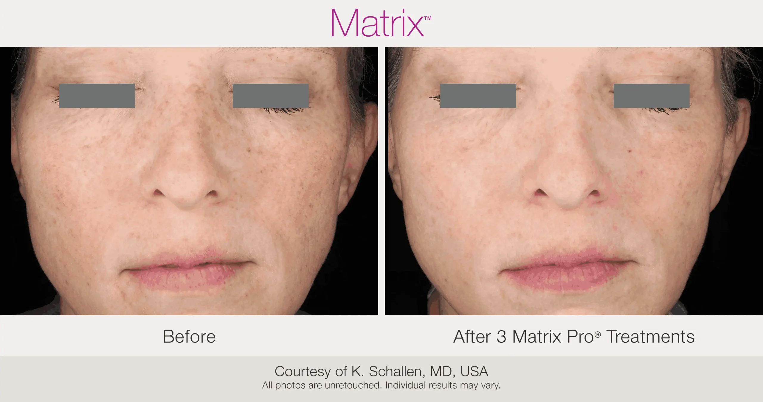 Skin Rejuvenation with Matrix-Before-After (46)