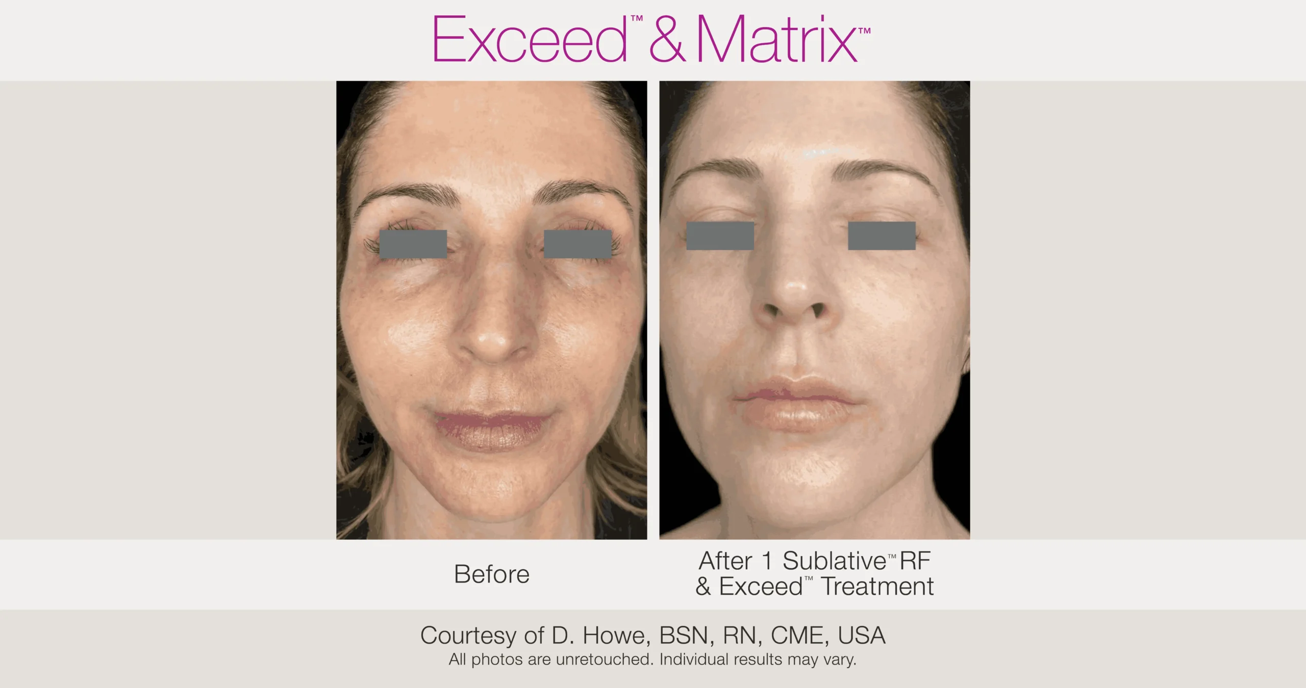 Skin Rejuvenation with Matrix-Before-After (47)