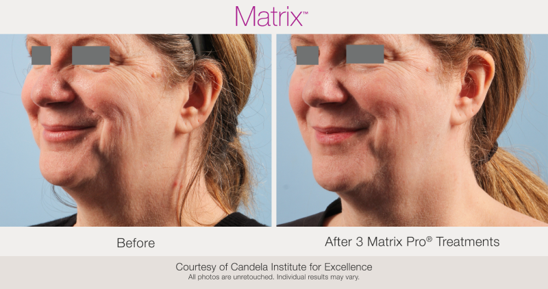 Skin Rejuvenation with Matrix-Before-After (5)