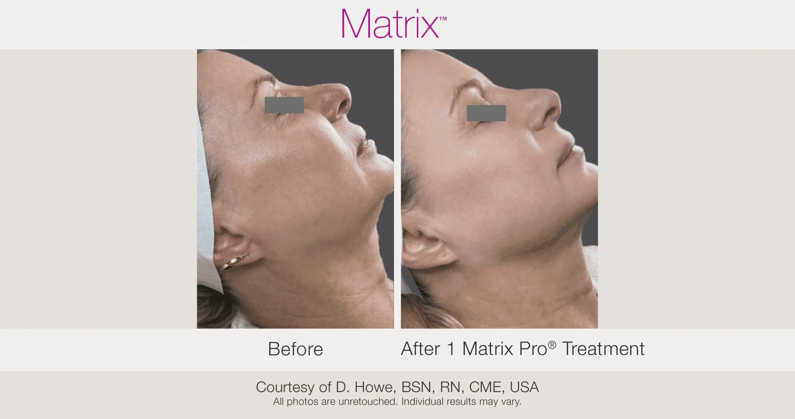 Skin Rejuvenation with Matrix-Before-After (50)