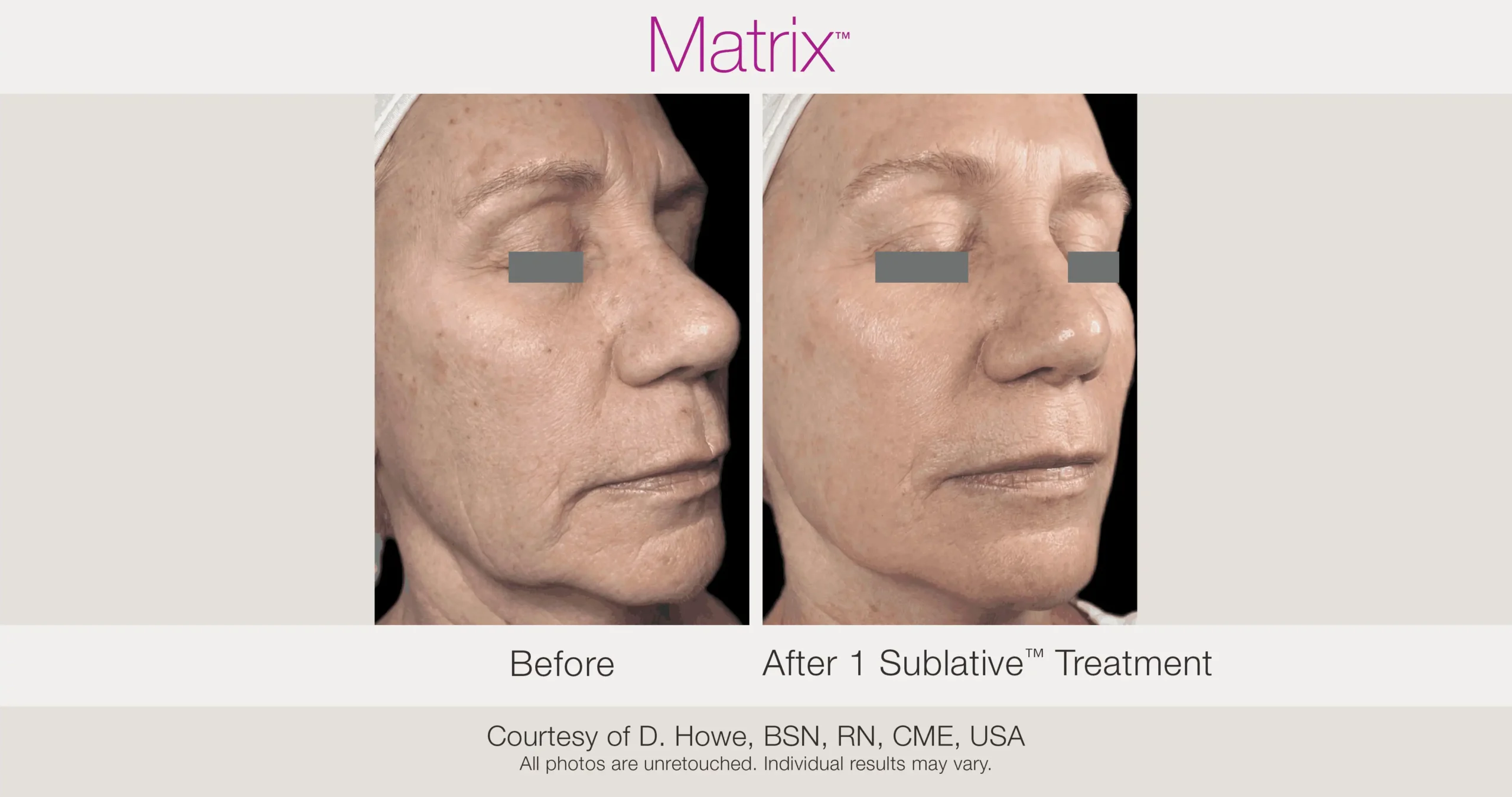 Skin Rejuvenation with Matrix-Before-After (51)