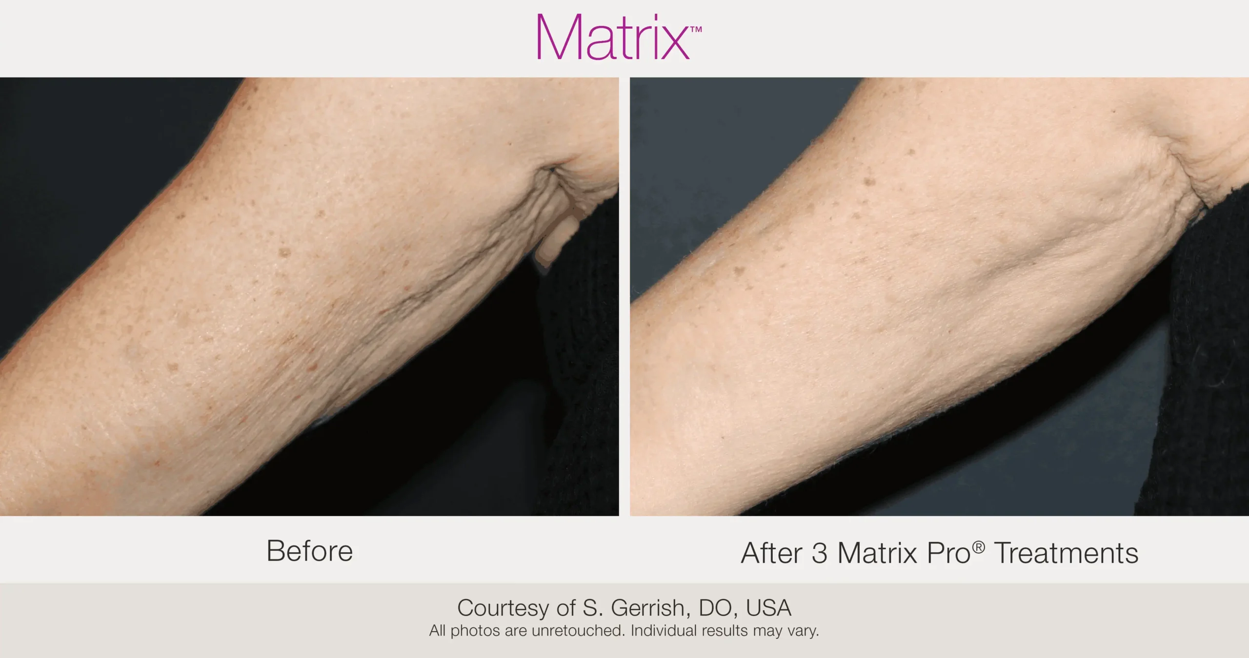 Skin Rejuvenation with Matrix-Before-After (52)