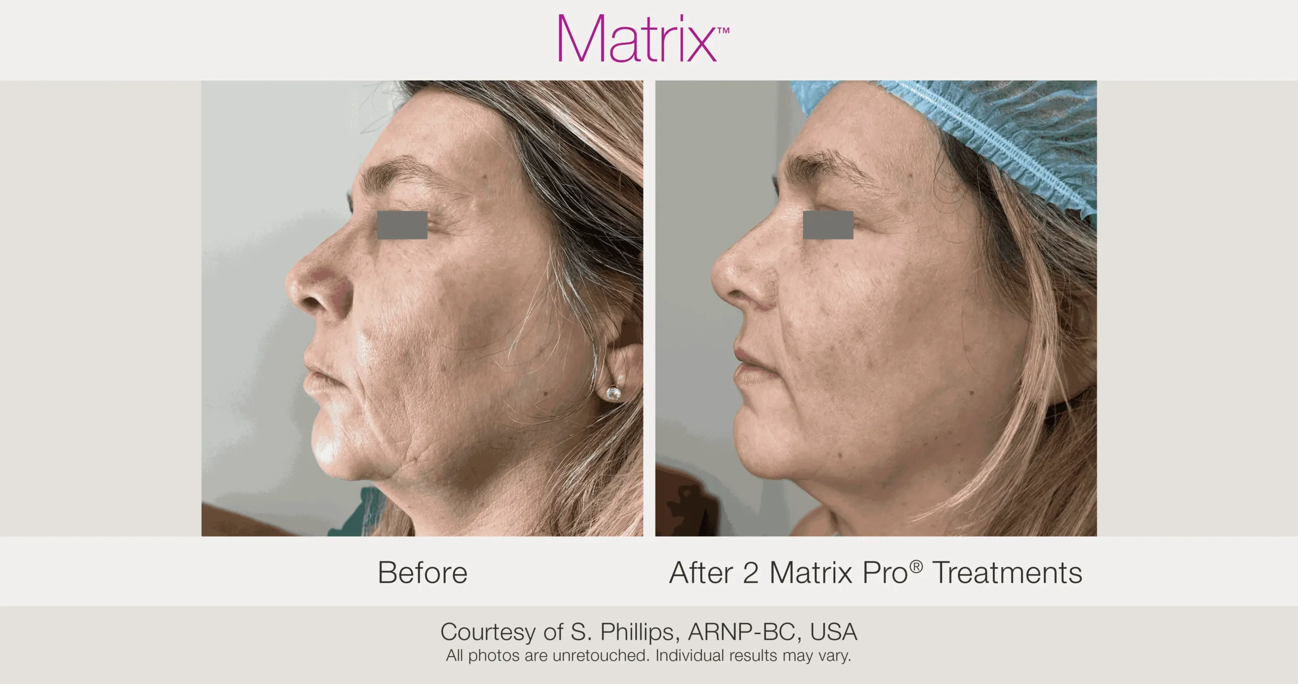 Skin Rejuvenation with Matrix-Before-After (53)