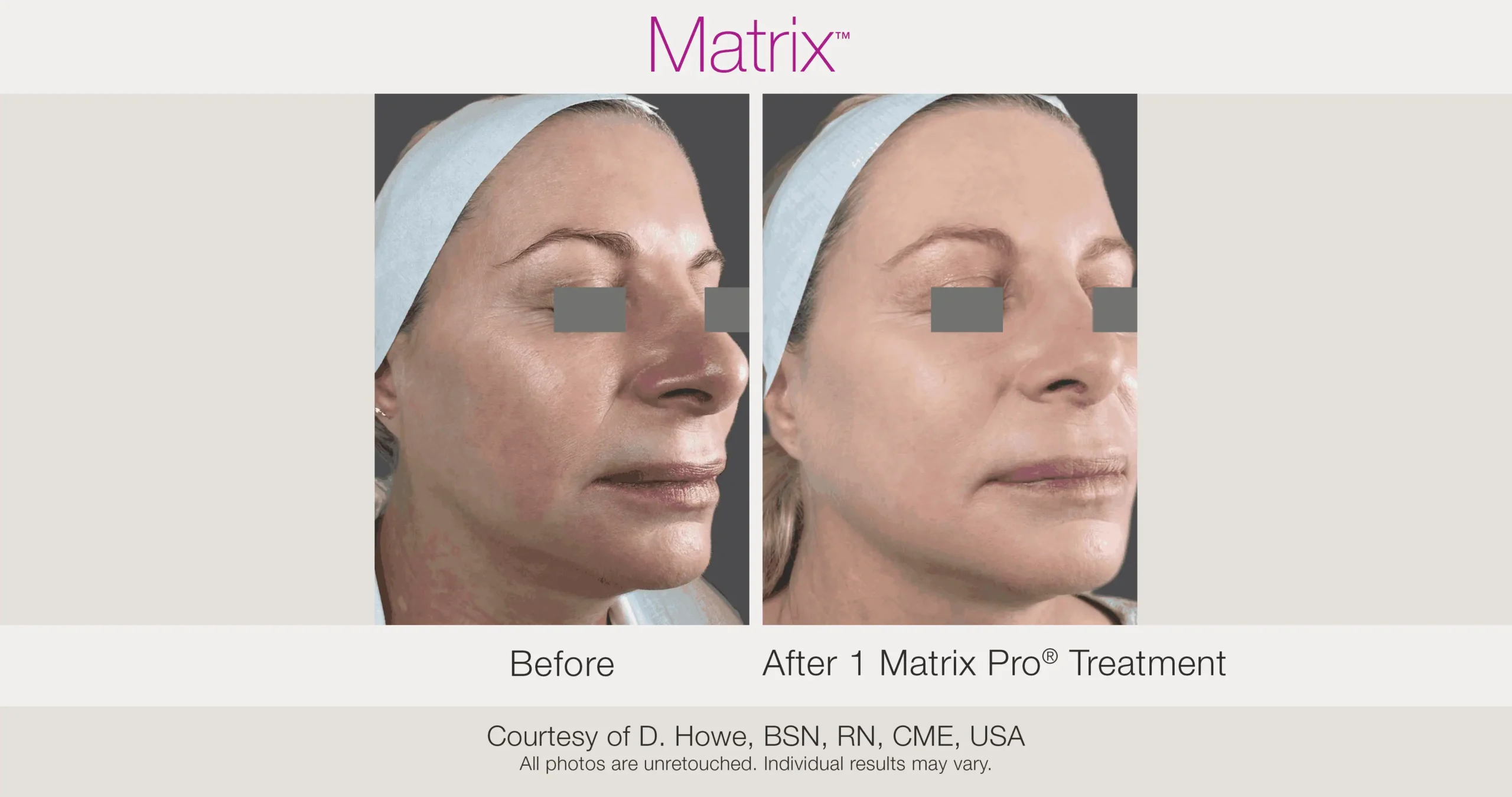 Skin Rejuvenation with Matrix-Before-After (54)