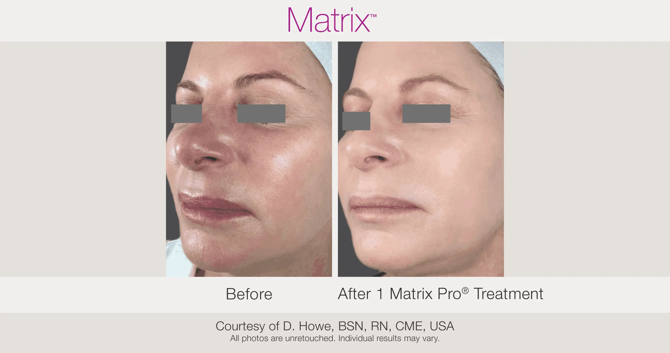 Skin Rejuvenation with Matrix-Before-After (56)