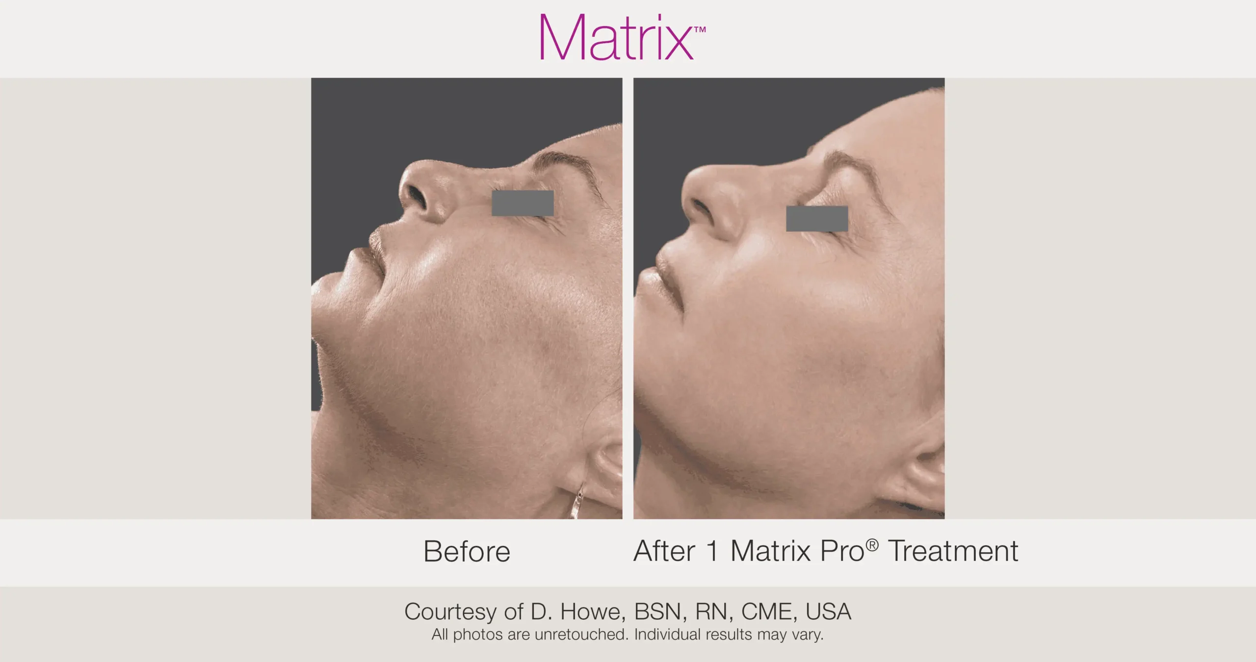 Skin Rejuvenation with Matrix-Before-After (57)