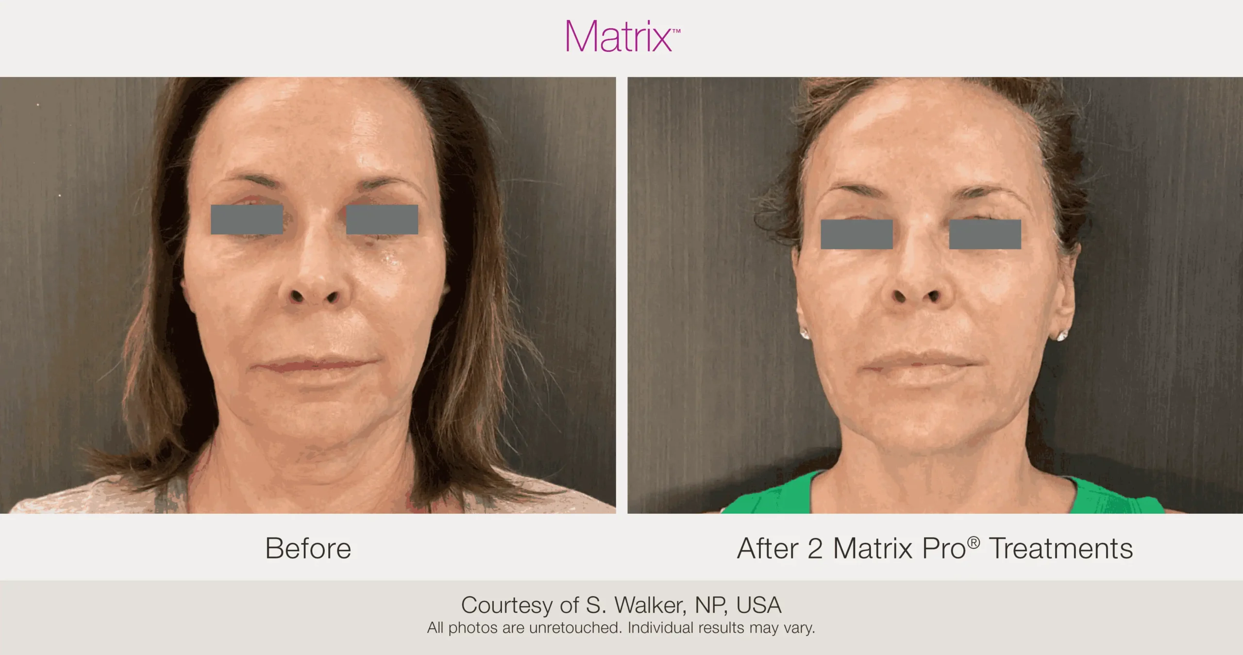 Skin Rejuvenation with Matrix-Before-After (59)