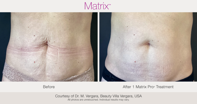 Skin Rejuvenation with Matrix-Before-After (6)
