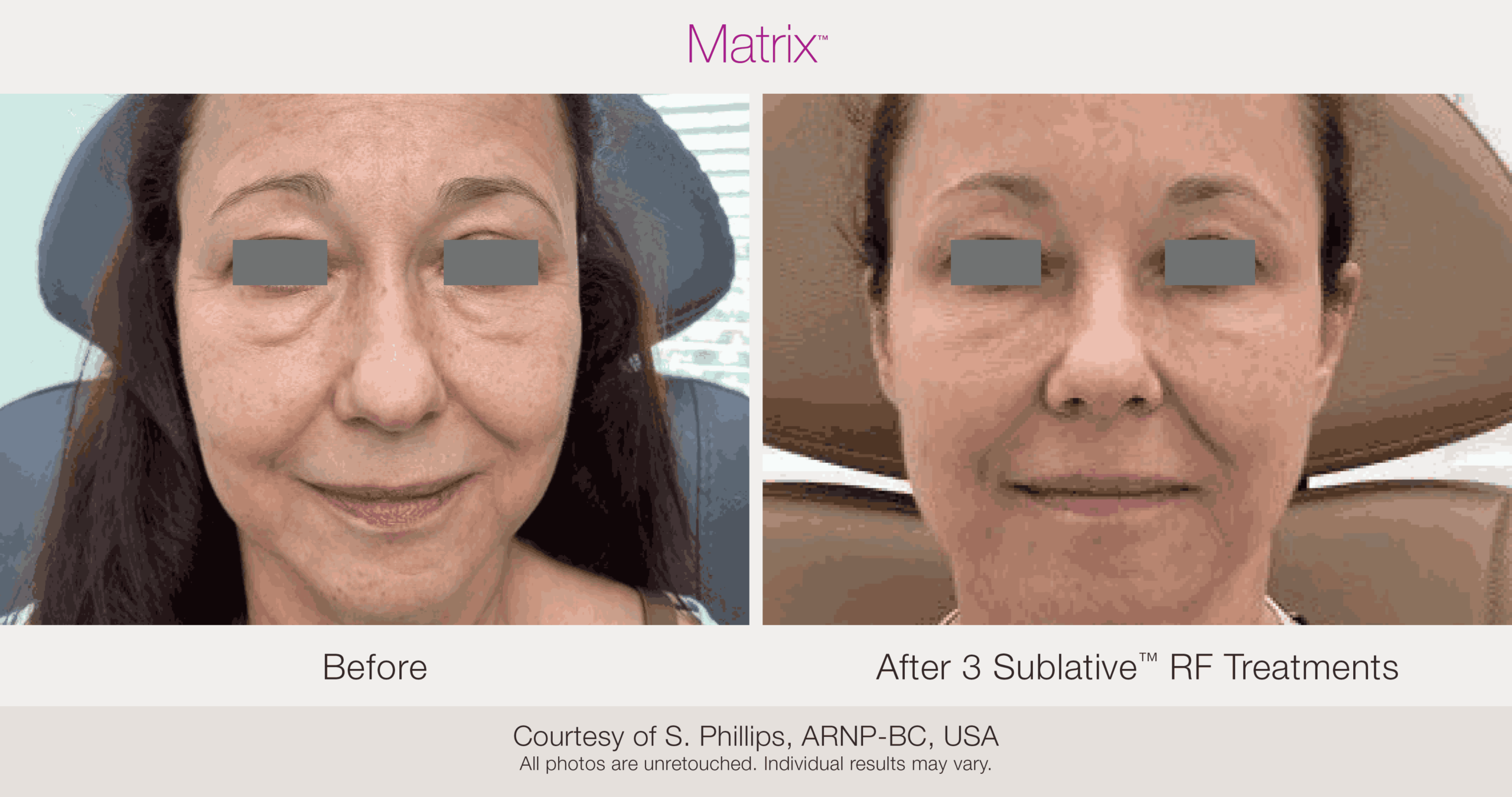 Skin Rejuvenation with Matrix-Before-After (60)